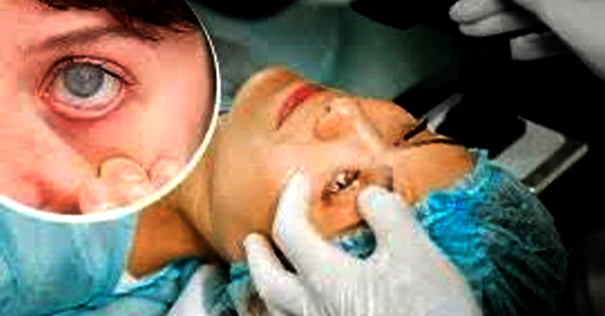 DEBUNKING MYTHS: CATARACT SURGERY & SUMMER