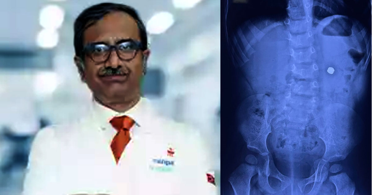 Race against time: 19-month-old Agastya saved by scarless surgery after swallowing magnetic battery by Manipal Hospital Mukundapur